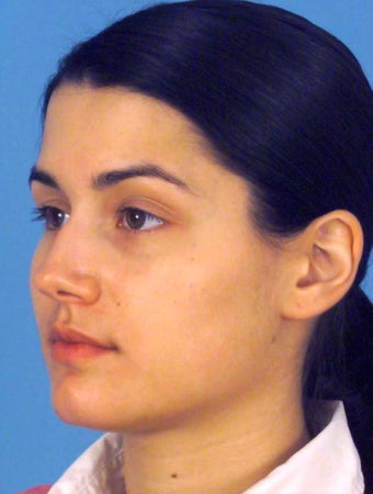 Septorhinoplasty