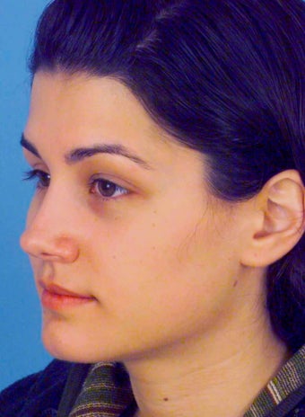 Septorhinoplasty