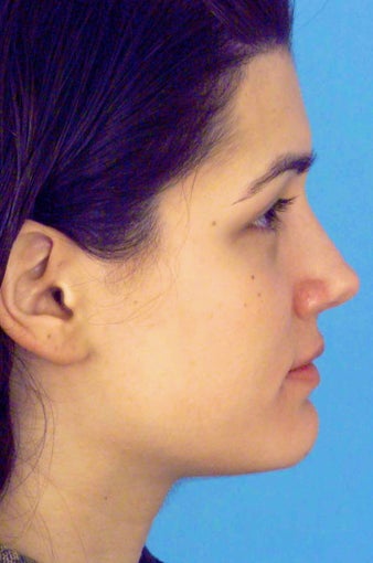 Septorhinoplasty