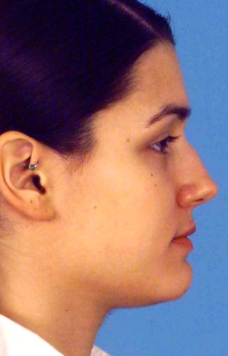 Septorhinoplasty