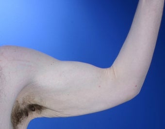 36 year old male weight loss patient with arm laxity