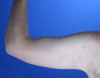 36 year old male weight loss patient with arm laxity