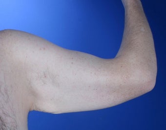 36 year old male weight loss patient with arm laxity