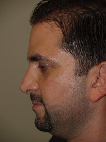 Before and After Revision Rhinoplasty