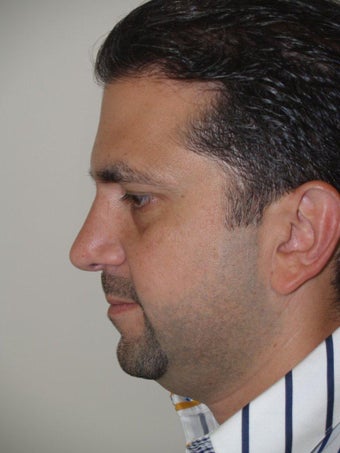 Before and After Revision Rhinoplasty