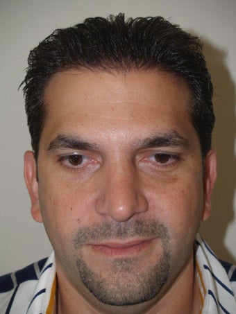 Before and After Revision Rhinoplasty