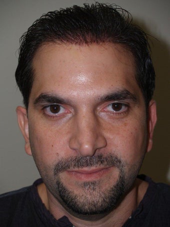 Before and After Revision Rhinoplasty