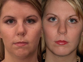 Chin Augmentation