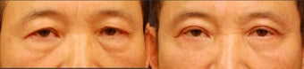 Male Upper and Lower Eyelid Surgery