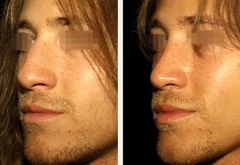 22 year-old male with a nose he feels is “too big” in proportion to the rest of his facial features.