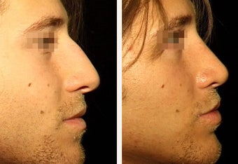 22 year-old male with a nose he feels is “too big” in proportion to the rest of his facial features.