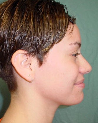 Septorhinoplasty