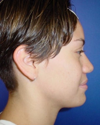 Septorhinoplasty