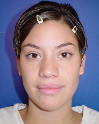 Septorhinoplasty