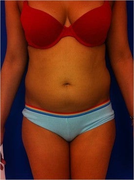 Laser Liposuction