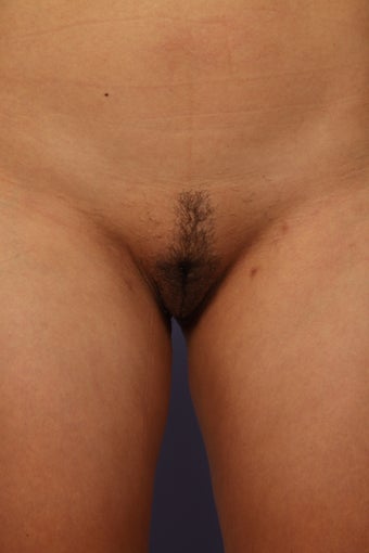 Labiaplasty