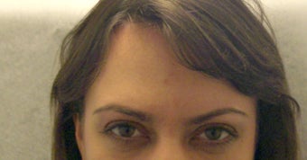 Botox