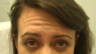 Botox