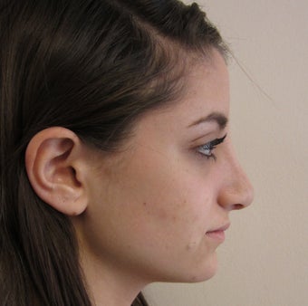 19 Year Old Treated for Aesthetic Nasal Deformity