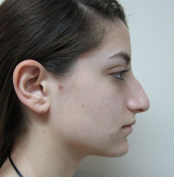 19 Year Old Treated for Aesthetic Nasal Deformity