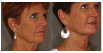 Luminous Lift 