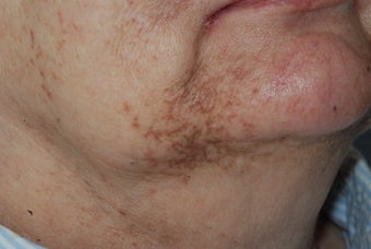 Cutera Laser Limelight Treatment