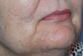 Cutera Laser Limelight Treatment