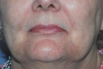 Cutera Laser Limelight Treatment