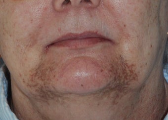 Cutera Laser Limelight Treatment