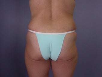 Bodylift
