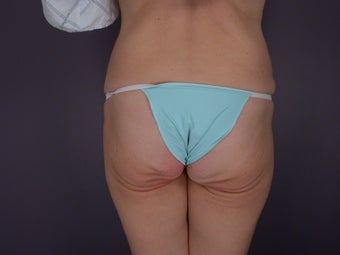 Bodylift