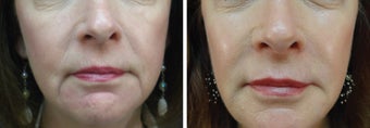 61 Year Old Female with facial fillers, skin care, and Botox