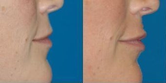 Lip filler with Juvederm