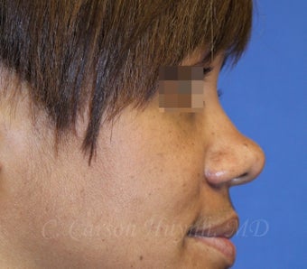 Young woman with bulbous nose treated with rhinoplasty