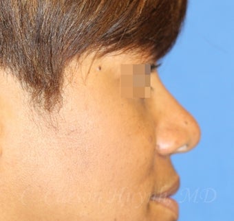 Young woman with bulbous nose treated with rhinoplasty