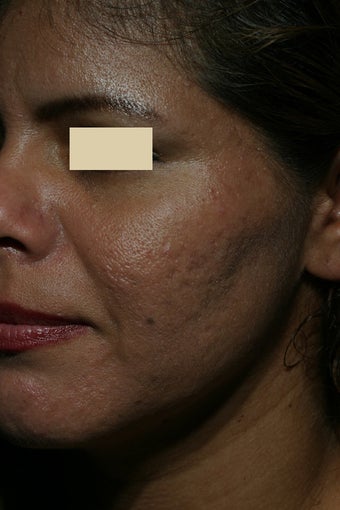 Acne scars