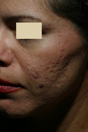 Acne scars