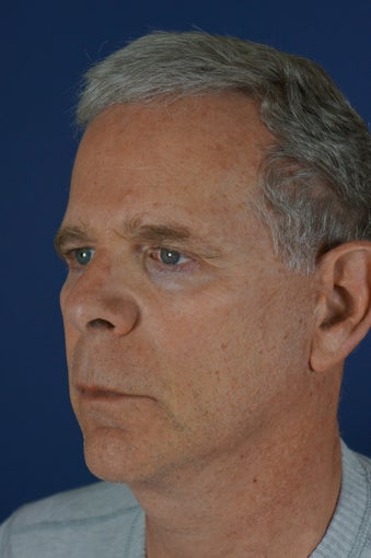 60 year male with liquid facelift