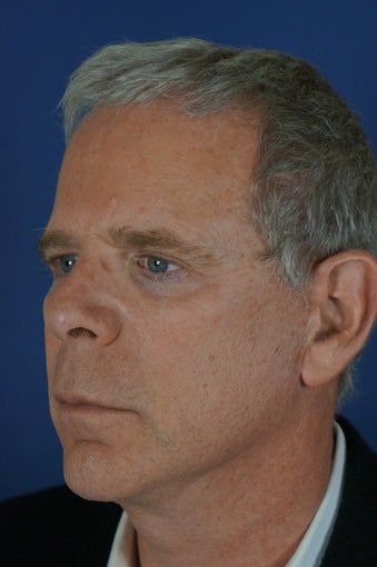 60 year male with liquid facelift