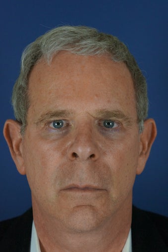 60 year male with liquid facelift