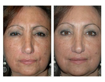 Botox for Frown Lines