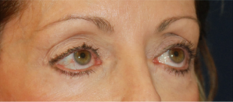 Eye Bag Surgery