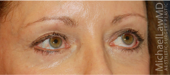 Eye Bag Surgery