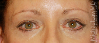 Eye Bag Surgery