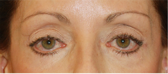 Eye Bag Surgery