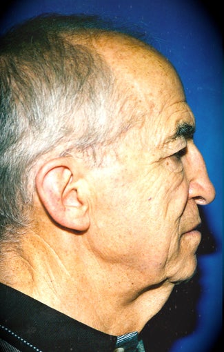 Necklift