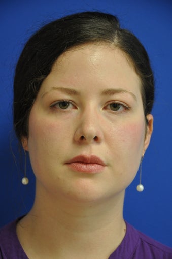 secondary rhinoplasty/revision rhinoplasty