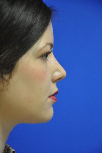 secondary rhinoplasty/revision rhinoplasty