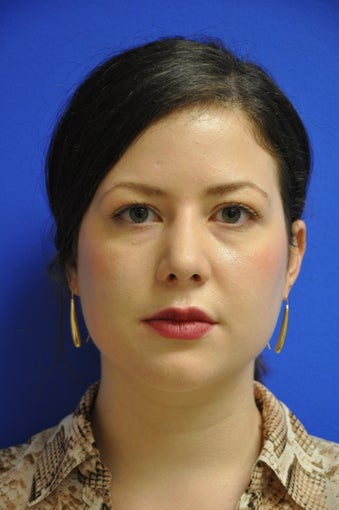 secondary rhinoplasty/revision rhinoplasty
