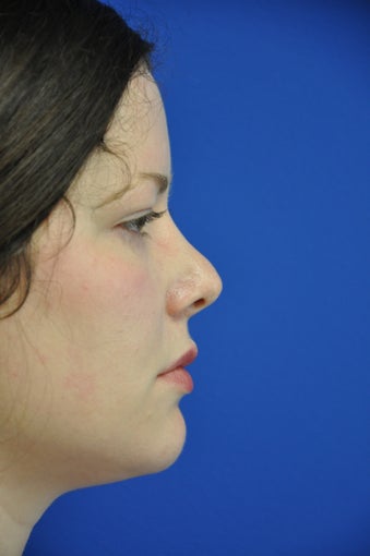 secondary rhinoplasty/revision rhinoplasty